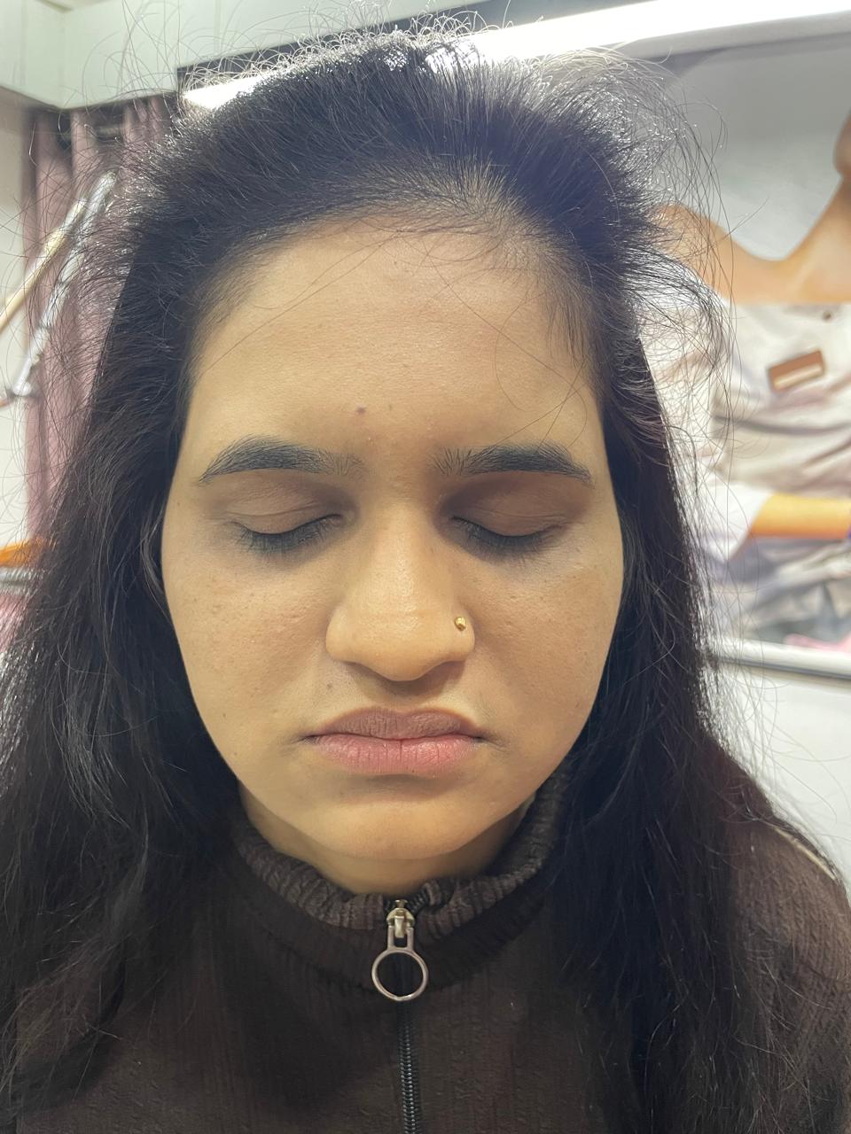 Before - Under Eye Hollowness Filling